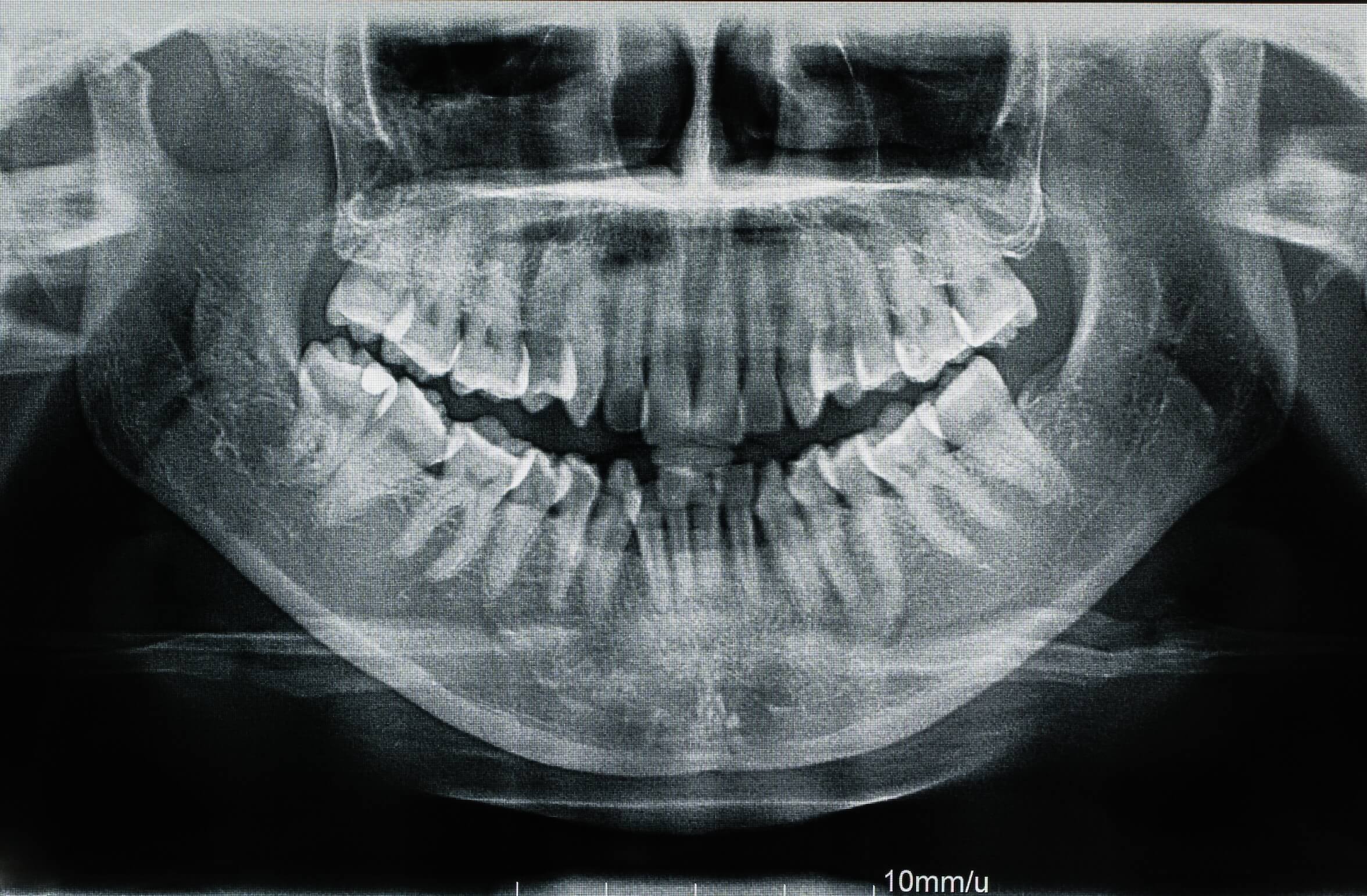 Panoramic X-Rays