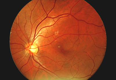 Retinal Imaging